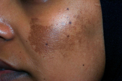 What Is Melasma (Chloasma or Mask of Pregnancy)?